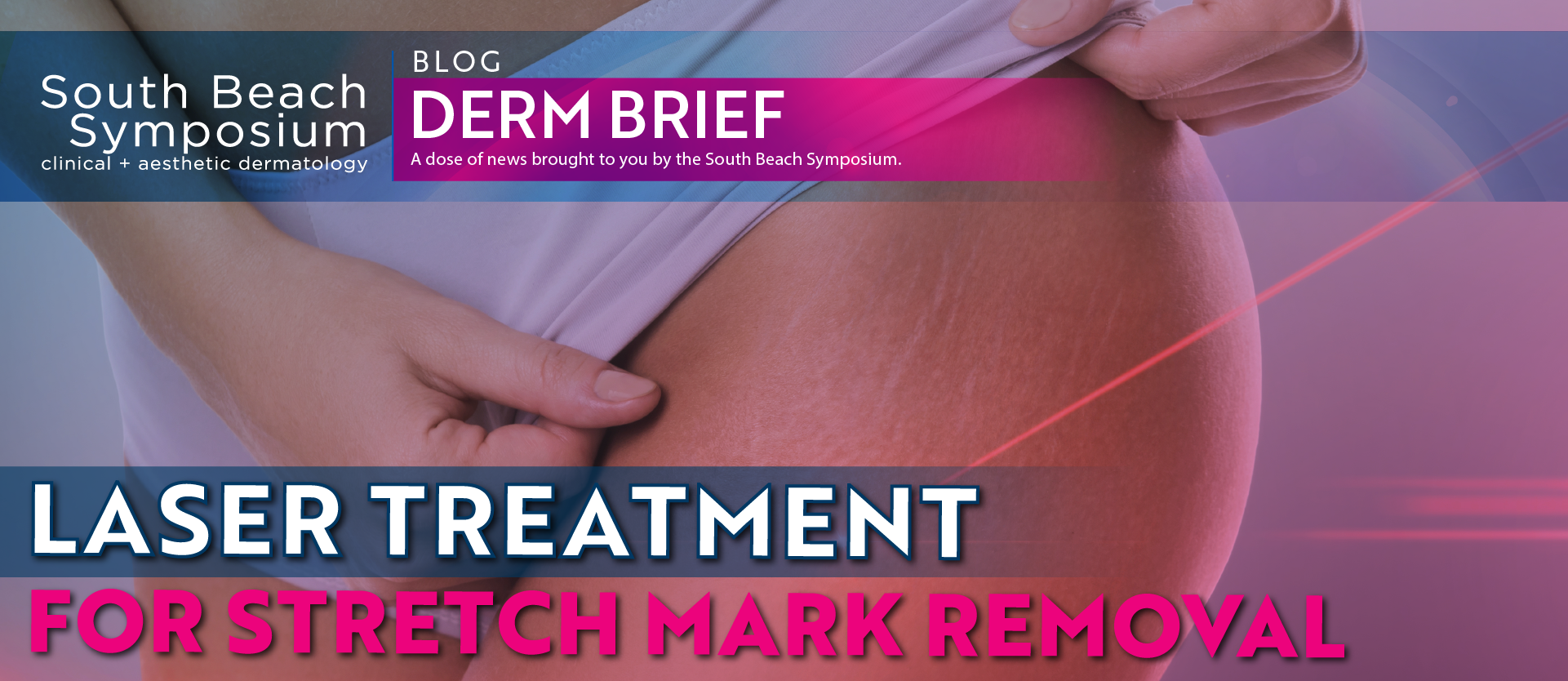 Laser Treatment For Stretch Mark Removal Livderm