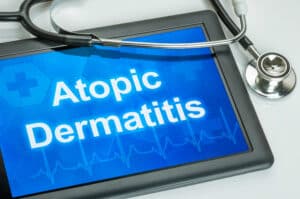 atopic dermatitis