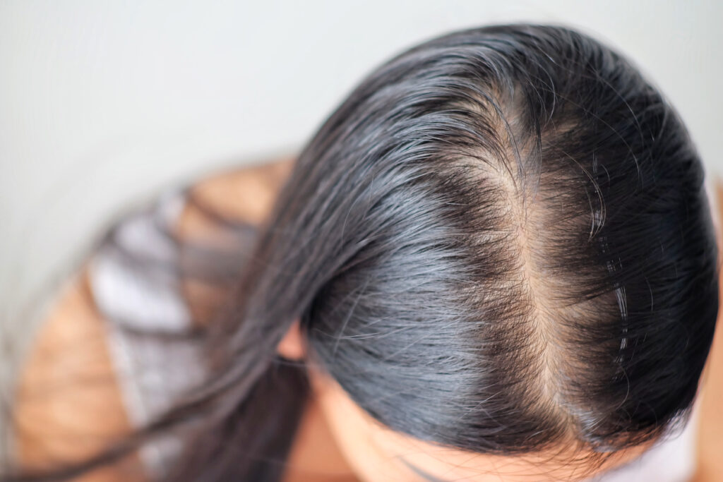 hair loss