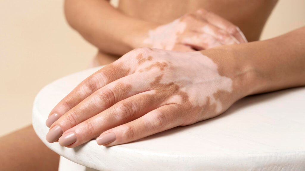 vitiligo