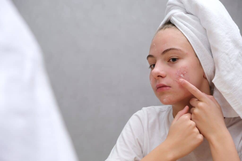 acne treatment