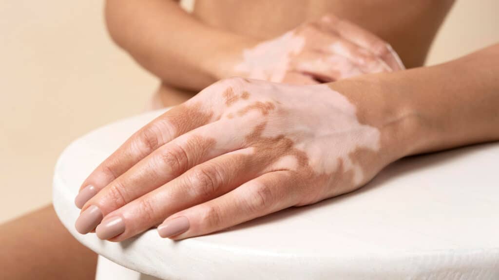 vitiligo