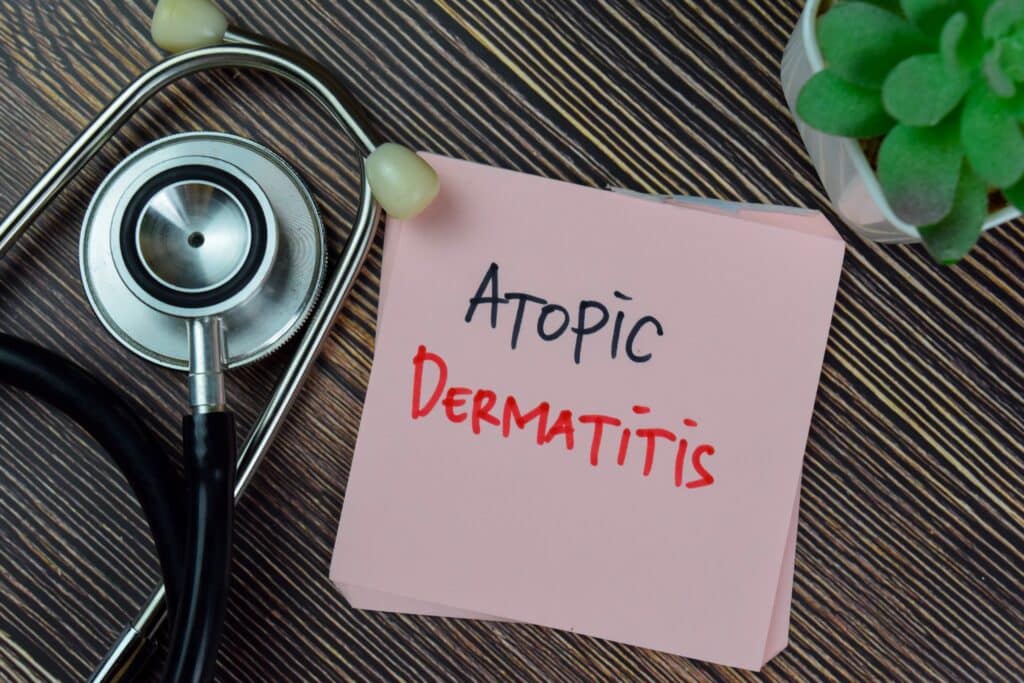 atopic dermatitis