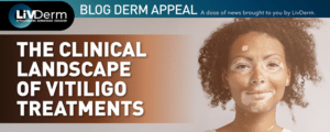 vitiligo treatment