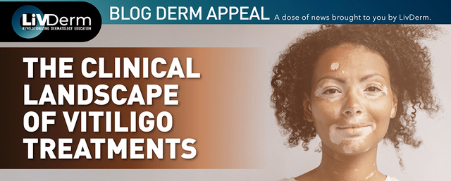 vitiligo treatment
