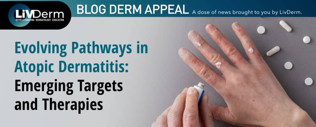 atopic dermatitis