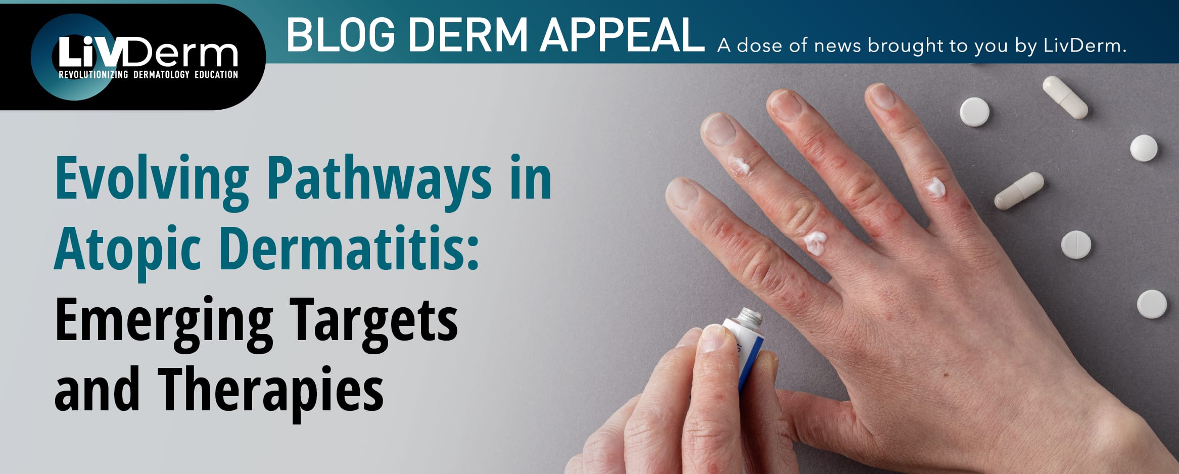 atopic dermatitis